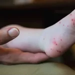 হ্যান্ড ফুট এন্ড মাউথ ডিজিজ ট্রিটমেন্ট, লক্ষণ, ঔষধ, খাবার